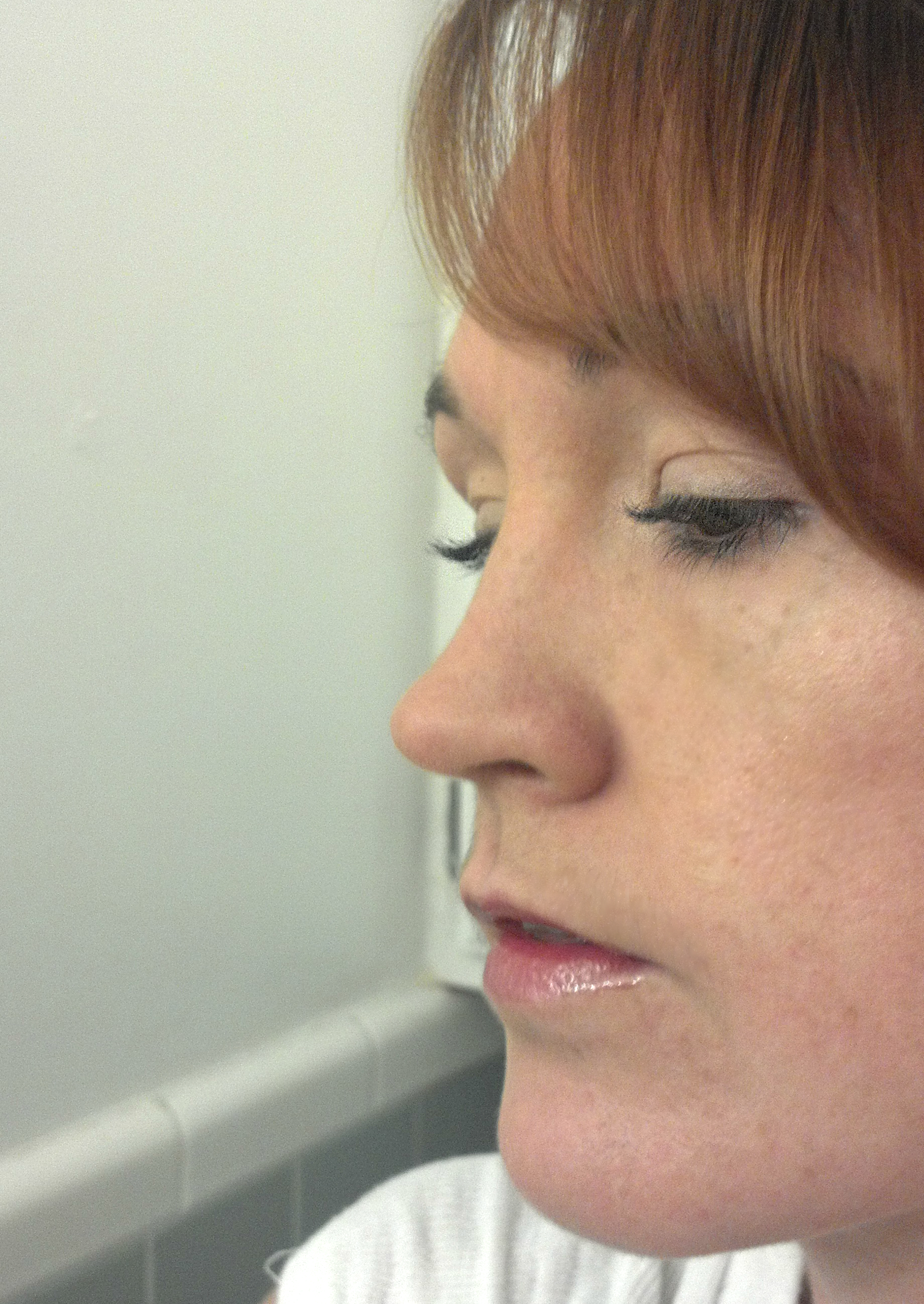 Open Bite My Jaw Surgery Journey Urban Earthworm